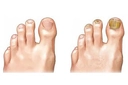 Ayak Baş Parmak Mantarı Belirtileri ve Tedavisi Ayak Baş Parmak Mantarı Belirtileri ve Tedavisi