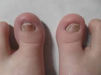 Bebeklerde Ayak Tırnak Mantarı Belirtileri ve Tedavisi Bebeklerde Ayak Tırnak Mantarı Belirtileri ve Tedavisi